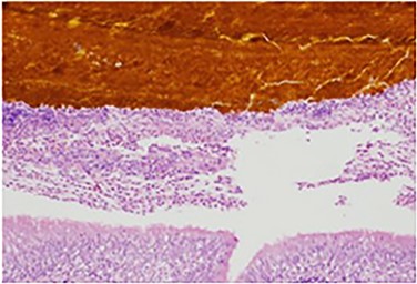 Specimen histology demonstrating bilirubin deposits within the lung parenchyma