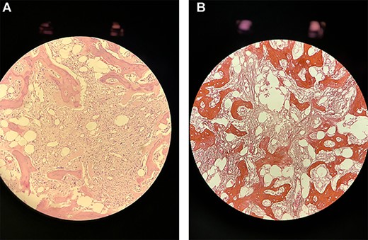 (A) A single core biopsy of bone morrow showing hypocellular morrow with extensive fibrosis and almost devoid of hemopoietic cells (B) a single core biopsy of bone morrow after the addition of Reticulin stain.