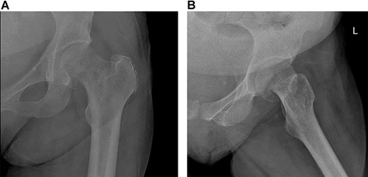 Mildly displaced fracture involving head/neck junction of the left proximal femur with suspected underlying lucency.