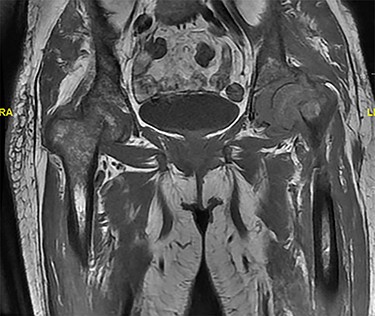 MRI showing displaced fracture noted at the left femoral neck and subcapital right femoral neck fracture with minimal reactive changes.