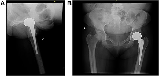 (A) Left (L) view of the implant in position; (B) Pelvic X-ray showing the implant in position.