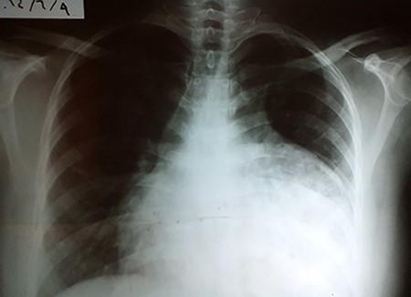 CXR showing an abnormal heart index and opacity that covers the left pleural angle.