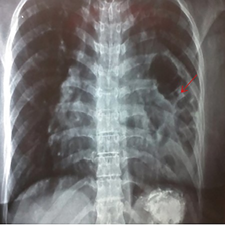 Showing an abnormal barium swallow with viscera (red arrow) in the left hemi-thorax.