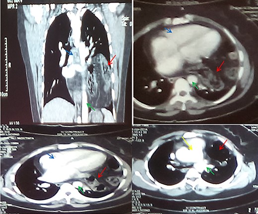 CT sections with contrast showing abdominal viscera in the thorax (red arrows), aorta (green arrow), the heart (blue arrows) and the pulmonary trunk (yellow arrow).