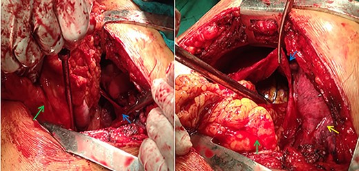 Real pictures in surgery shwoing the viscera (green arrows), the pericardium (blue arrows) and the lungs (yellow arrow).