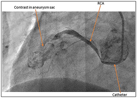 Coronary artery angiogram showing extravasation of contrast into the aneurysm sac.