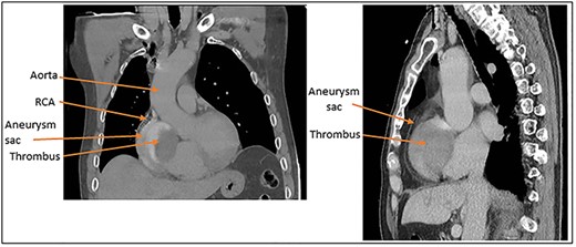 (A) Coronal and (B) sagittal CT images of the large aneurysm sitting over the right side of the heart and the thrombus within the aneurysm.