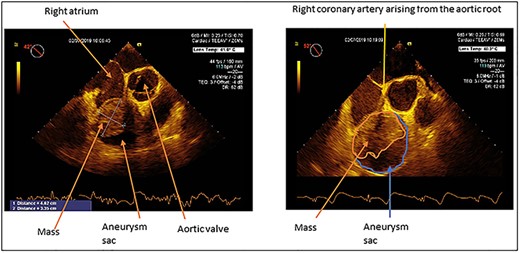 Transoesophageal echo demonstrating RCA aneurysm with a mass partially filling the aneurysm sac. The size of the mass is 4.62 by 3.35 cm. The proximal RCA is seen originating from the aortic root.