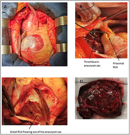 Intraoperative images. Image (A) shows the very dilated RCA visible upon opening the pericardium. Image (B) shows the unaffected portion of the proximal RCA feeding into the aneurysm sac, thrombus can be seen within the sac. Image (C), taken after the thrombus has been removed from the sac, shows the unaffected distal RCA. Image (C) also shows that there are no atherosclerotic plaques or evidence of previous thrombotic events within the aneurysm sac. This finding supports the theory that thrombus formation was an acute event which led to the patient presenting with an STEMI. Image (D) shows the fresh thrombus after it was removed from the aneurysm sac.