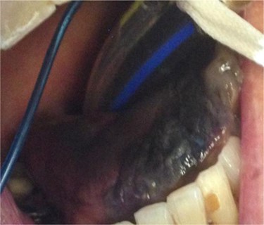 Necrosis of the tip of tongue.