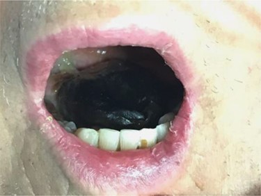 Bilateral dorsal tongue involvements.