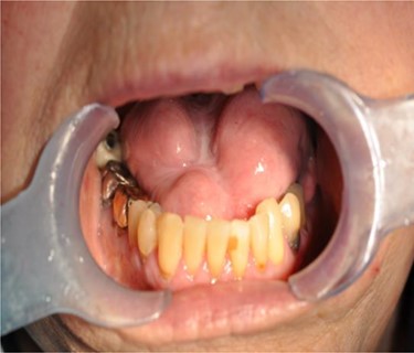 Extensive scarring of the tongue.