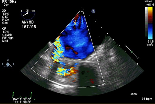 Transesophageal echocardiography demonstrated that the mechanical prosthesis had focal dehiscence with severe perivalvular leakage.