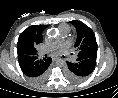 The aortic homograft was circumferentially calcified as shown by a preoperative chest computed tomography scan.