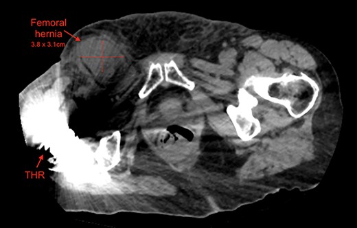 Axial view of right femoral hernia, note the significant image distortion from the right total hip replacement beam artifacts.