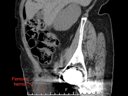 Sagittal view of right femoral hernia.