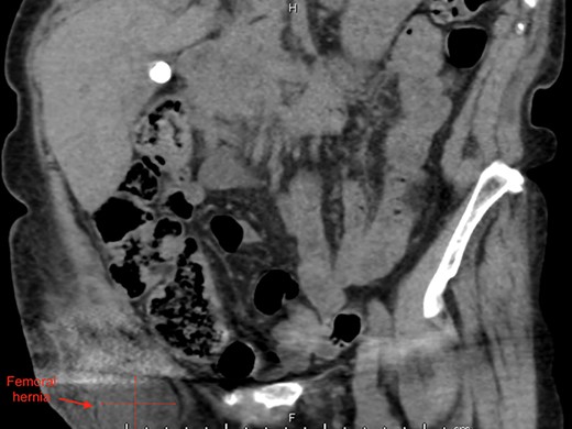 Coronal view of right femoral hernia.