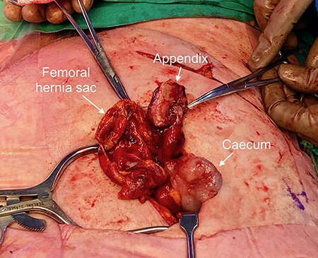 Macroscopic view of the open surgical field pointing toward patient feet. The McEvedy high incisional wound containing contents: right femoral hernia sac, perforated inflamed appendix and part of the caecum.