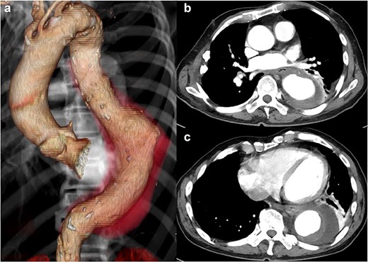 CT shows a descending aortic aneurysm (a), 50 mm in diameter (b), surrounded by an effusion (c).