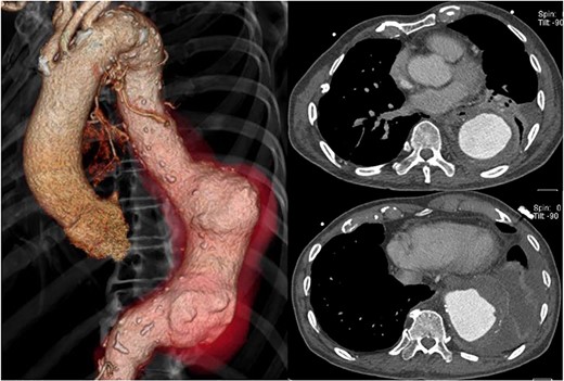 Preoperative CT shows acute expansion of the aneurysm to 70 mm in diameter.