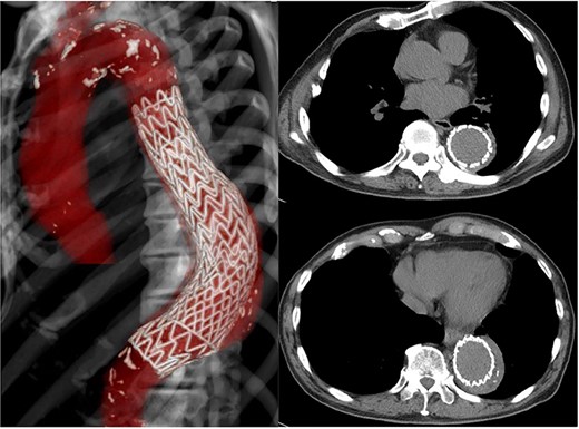 CT 15 months later shows regression of the aneurysm to 53 mm in diameter.