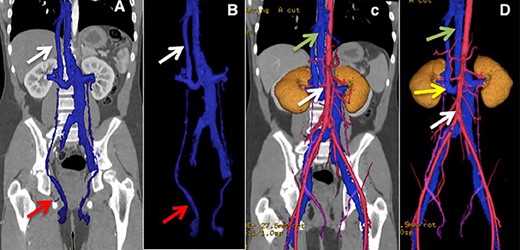 (A and B) Lower arrow shows testicular vein, upper arrow shows hypoplastic suprahepatic segment of the IVC. (C) Lower arrow shows aorta, upper arrow indicates azygos vein. (D) Lower arrow shows aorta, middle arrow shows retro-aortic right renal vein, upper arrow shows azygos vein.