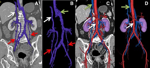 (A) Lower arrows show ovarian veins, upper arrow shows hypoplastic suprahepatic segment of the IVC. (B) Lower arrows show ovarian veins, right upper arrow shows hypoplastic suprahepatic segment of the IVC, left upper arrow shows azygos vein. (C and D) Lower arrow shows aorta, upper arrow shows azygos vein.