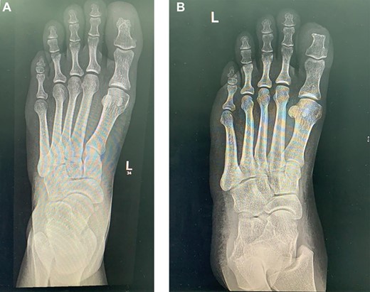 Left foot X-ray at presentation.