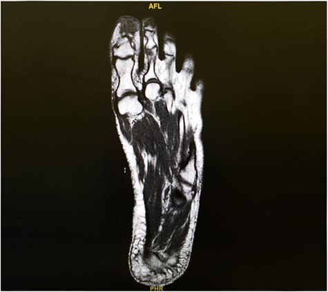 Pre-excision MRI for the right foot showing a 2-cm soft tissue focus at the tip and plantar aspect of big toe closely adherent to the tuft of distal phalanx but with no evidence of bony destruction.