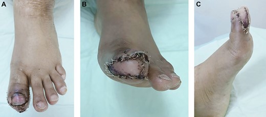 One-week post excision and coverage with Kutler bilateral V-Y advancement flaps.