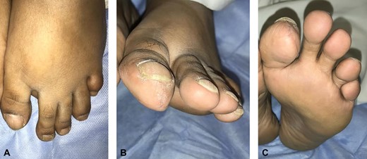 19 months post excision and coverage with Kutler bilateral V-Y advancement flaps with no evidence of recurrence.