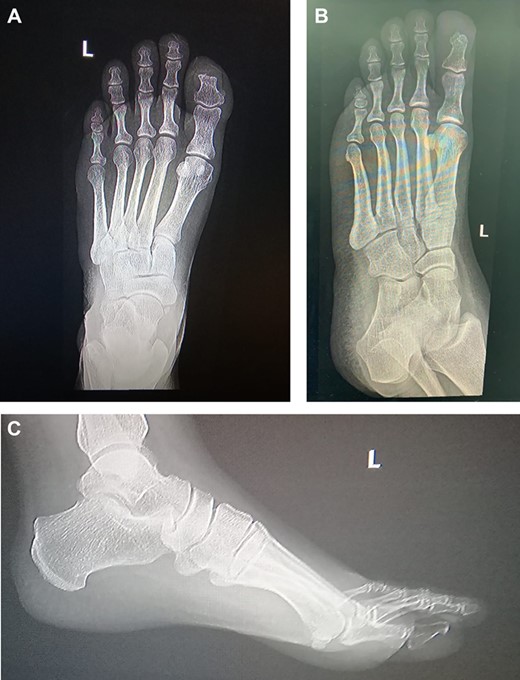 Left foot X-ray 19 months post excision and coverage with Kutler bilateral V-Y advancement flaps no evidence of recurrence.