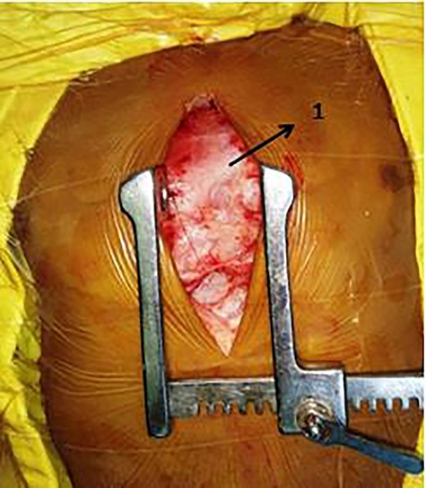 Intraoperative picture of thickened pericardium (1—thick, whitish and glistening anterior pericardium).