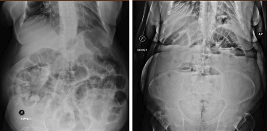 Both supine and erect X-ray show dilatation of the small-bowel.