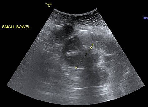 Fluid-filled small bowels with dilatation (widest diameter: 3.5 cm).