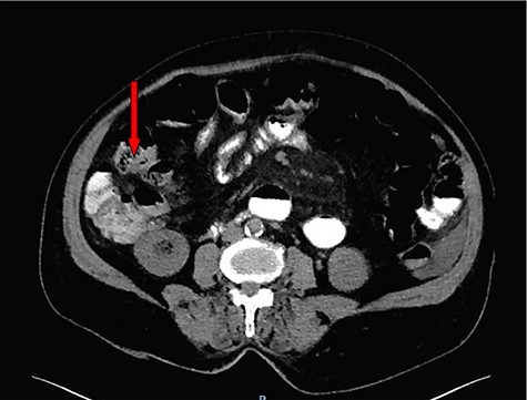 Contrast-enhanced CT scan suggests an appearance of intraluminal debris containing air bubbles ‘mottled appearance’.