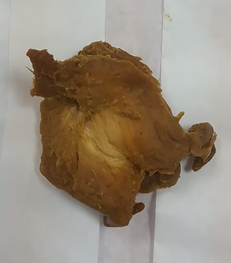 Retrieved phytobezoar.