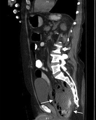 CT sagittal view showing contrast (white) entering the lumen of presacral abscess and rectus abdominis muscle pushed anteriorly.