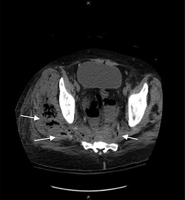 CT axial view showing tract from presacral space through the sciatic notch to thigh muscles.
