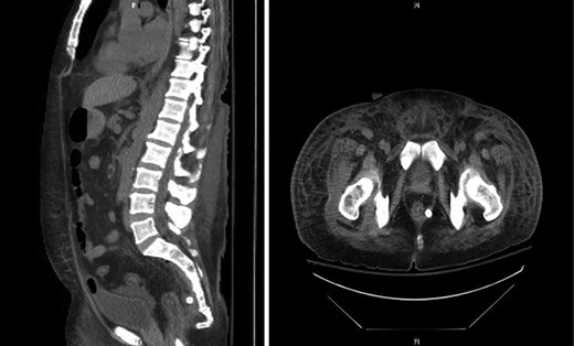 Computed tomography (sagittal and axial views) showing post-operative resolution of the presacral abscess (post-operative day 5).