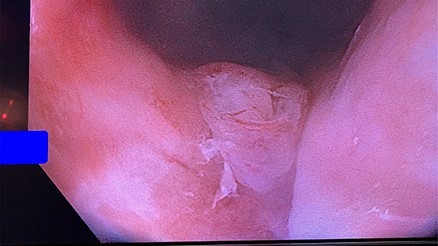 Flexible sigmoidoscopy demonstrating granulation tissue at the posterior aspect of the distal rectum.