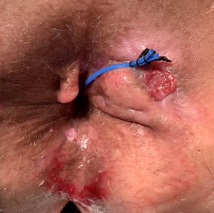 External view at post-operative day 65 demonstrating a right lateral subcutaneous fistula-in-ano with a seton in place. At the posterior midline, is granulation tissue from prior transperineal drain placement.