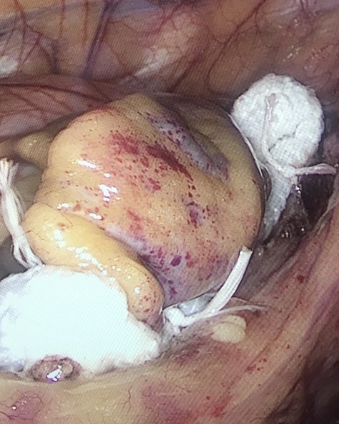 Atriclip™ in position at the base of the LAA.