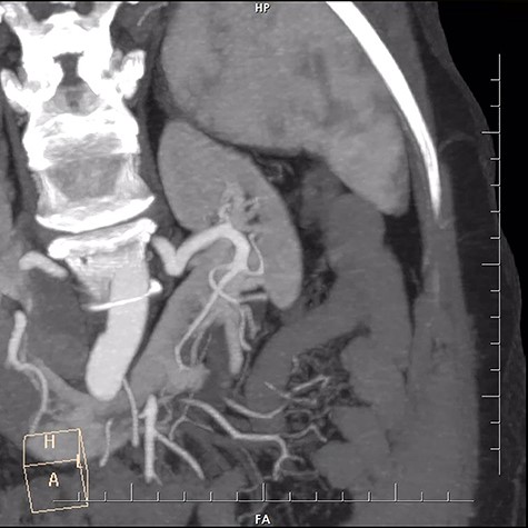 CT scan showing vasculature of kidneys.