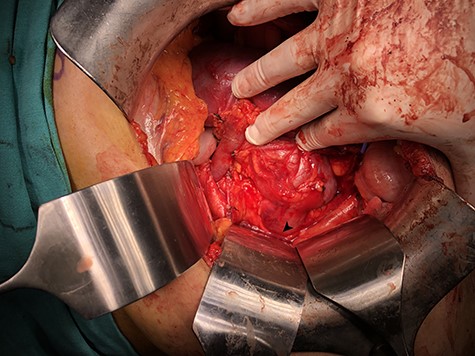 Demarcation zone formed on isthmus.