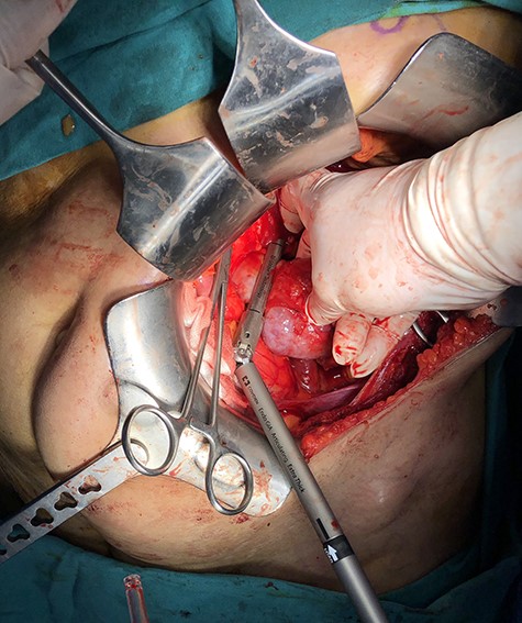 Dividing the isthmus parenchyma with stapler.
