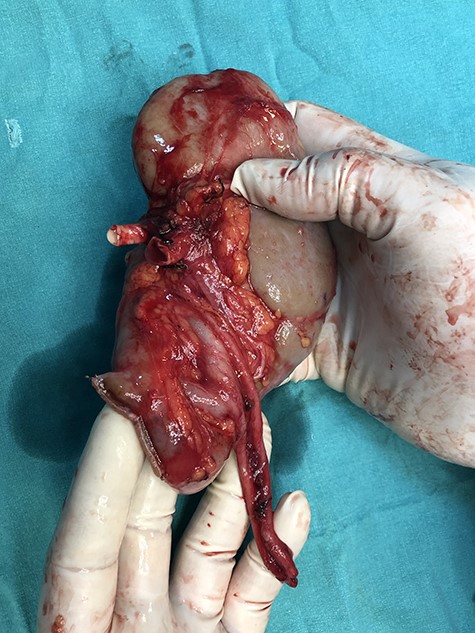 Cold perfused left kidney.