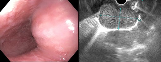 Esophagogastroduodenoscopy showed an esophageal prominence 2 cm above the GE junction with endoscopic ultrasound confirming 39.8 × 23.2 mm mass.