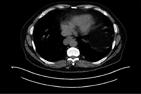 Computerized tomography (CT) demonstrated a right distal esophageal mass.