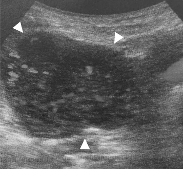 Abdominal ultrasonography: the tumor located lateral side of the right kidney, 40 mm in diameter (arrowhead). The tumor had much blood flow.